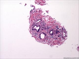 前列腺穿刺组织，18-19图是癌吗？图14