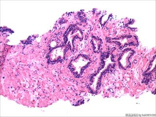 前列腺穿刺组织，18-19图是癌吗？图5