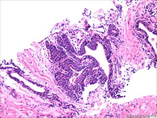 前列腺穿刺组织，18-19图是癌吗？图2
