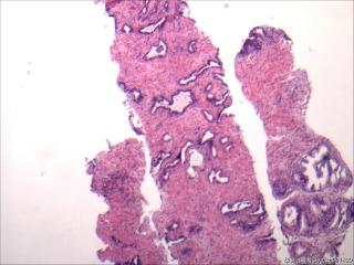 前列腺穿刺组织，18-19图是癌吗？图27