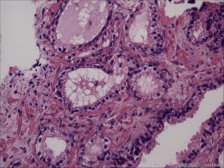 前列腺穿刺组织，18-19图是癌吗？图13