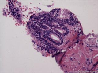 前列腺穿刺组织，18-19图是癌吗？图22