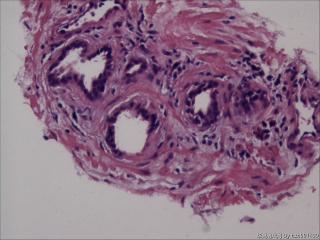 前列腺穿刺组织，18-19图是癌吗？图15