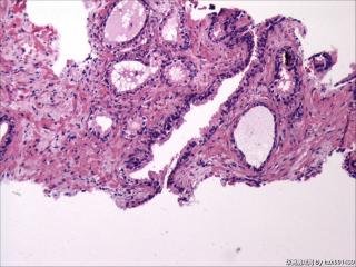 前列腺穿刺组织，18-19图是癌吗？图12