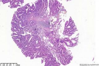 结肠息肉，高级别？图2