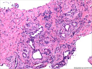 前列腺穿刺组织，18-19图是癌吗？图19