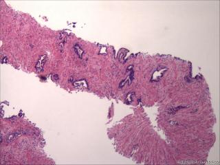 前列腺穿刺组织，18-19图是癌吗？图25
