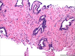 前列腺穿刺组织，18-19图是癌吗？图26