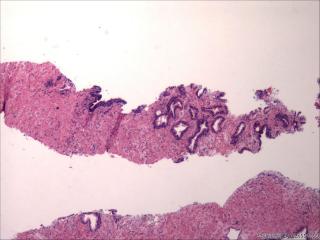 前列腺穿刺组织，18-19图是癌吗？图4