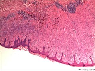 右侧胫前下段皮肤肿物图2