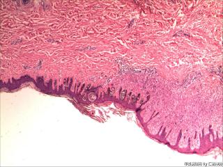 右侧胫前下段皮肤肿物图1