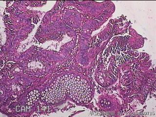 乙状结肠粘膜图3