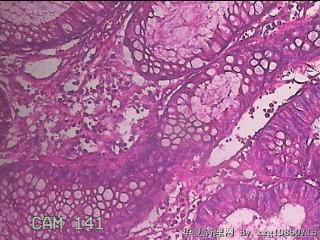 乙状结肠粘膜图37