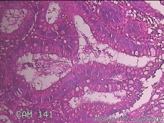 乙状结肠粘膜图23