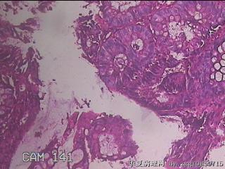 乙状结肠粘膜图35
