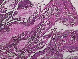 乙状结肠粘膜图4