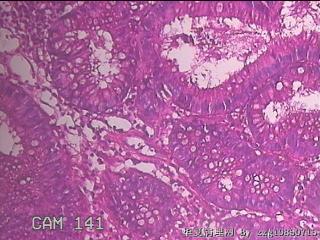 乙状结肠粘膜图26