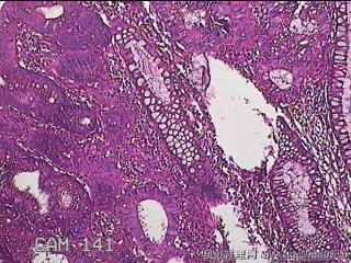 乙状结肠粘膜图13