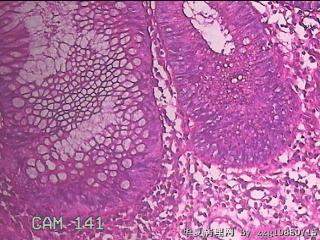 乙状结肠粘膜图42