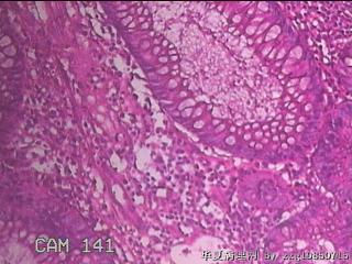 乙状结肠粘膜图41