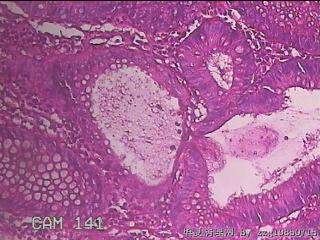乙状结肠粘膜图28