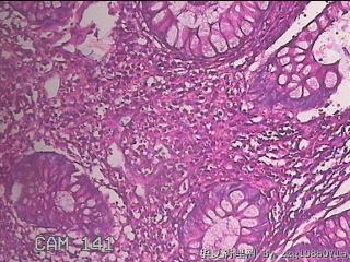 乙状结肠粘膜图50