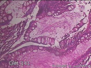 乙状结肠粘膜图36