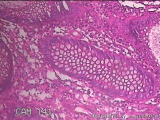 乙状结肠粘膜图39