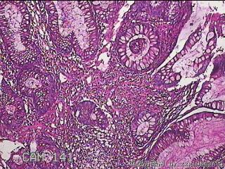 乙状结肠粘膜图11