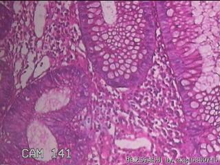 乙状结肠粘膜图45