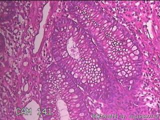 乙状结肠粘膜图46