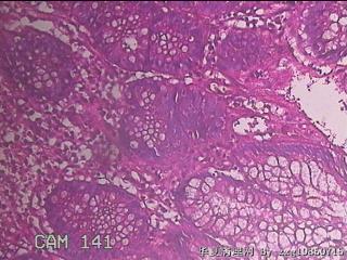 乙状结肠粘膜图24
