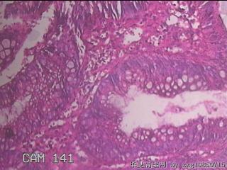 乙状结肠粘膜图18