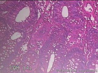 乙状结肠粘膜图44