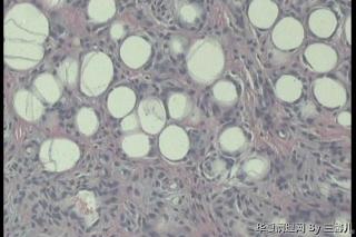左足皮下肿物，脂肪瘤见纤维母细胞增生吗？图6