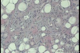 左足皮下肿物，脂肪瘤见纤维母细胞增生吗？图7