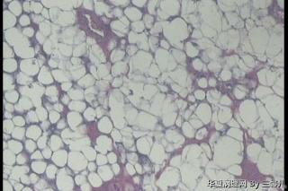 左足皮下肿物，脂肪瘤见纤维母细胞增生吗？图1