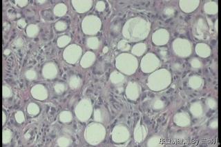 左足皮下肿物，脂肪瘤见纤维母细胞增生吗？图3