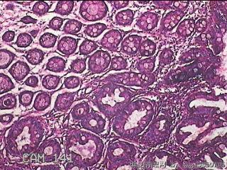 直乙结肠粘膜图13