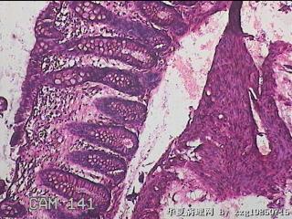 直乙结肠粘膜图21