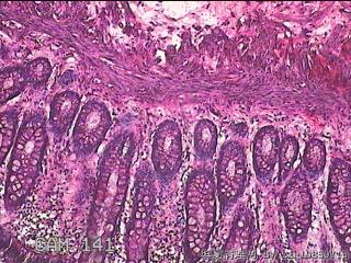 直乙结肠粘膜图3
