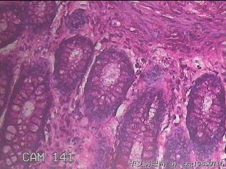 直乙结肠粘膜图30