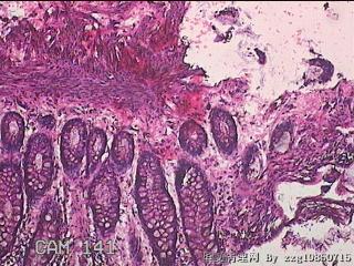 直乙结肠粘膜图2