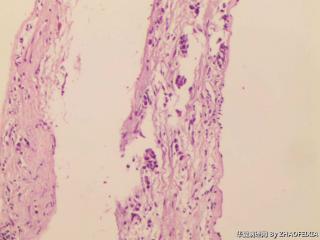 左肺纤支镜取出组织图8