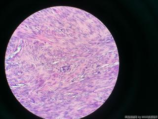 子宫肌瘤图4