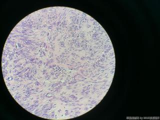 子宫肌瘤图8