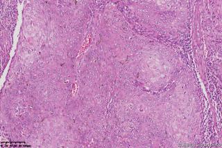 面部包块、高分化鳞状细胞癌？图7