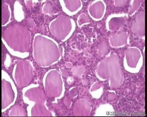 请教，甲状腺腺瘤伴淋巴细胞性甲状腺炎吗？图7