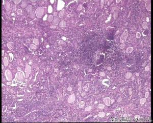 请教，甲状腺腺瘤伴淋巴细胞性甲状腺炎吗？图14