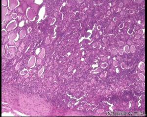 请教，甲状腺腺瘤伴淋巴细胞性甲状腺炎吗？图3